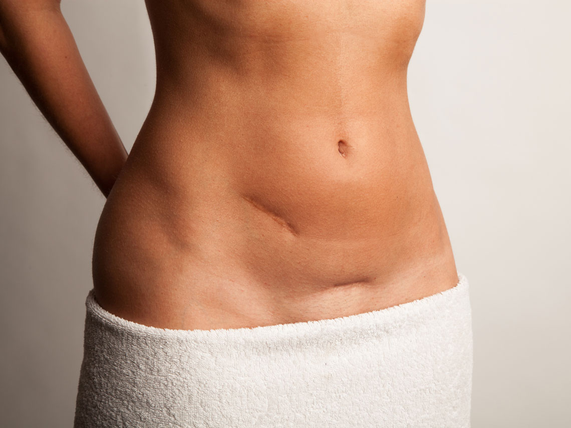 ¿De qué depende el éxito de una cesárea?